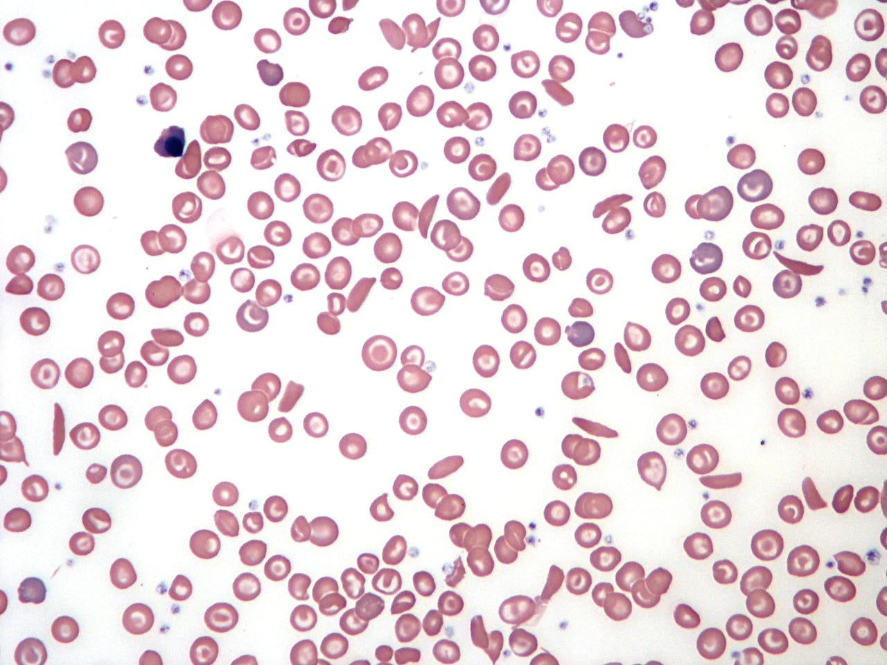 Medical weed keeps with sickle cell disease out of hospitals: study