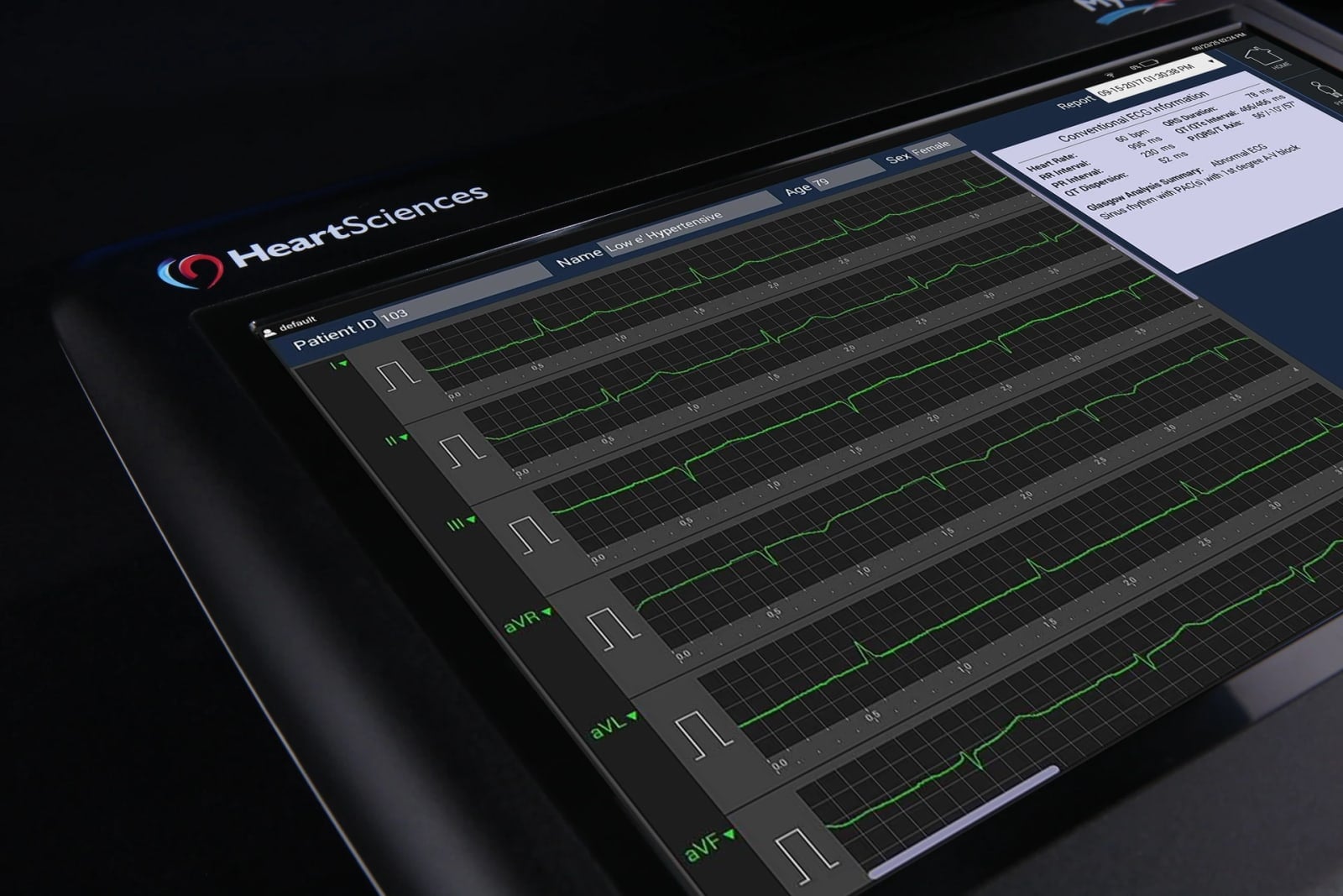 A MyoVista wavECG device displays electrocardiogram traces on its screen.