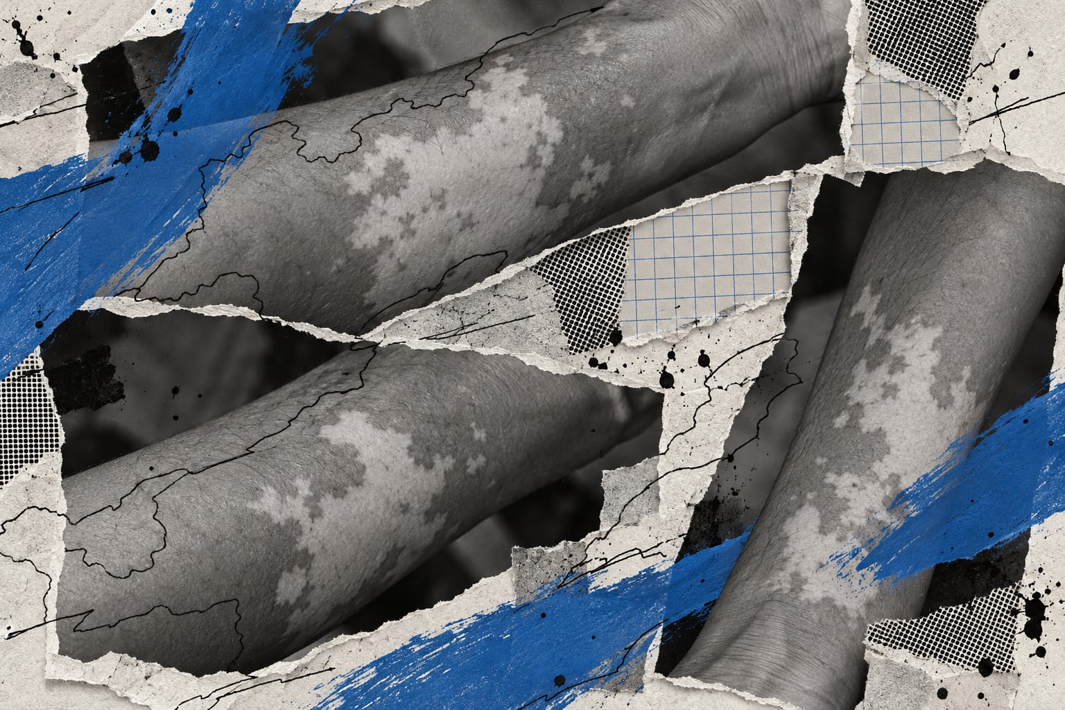 A mixed-media collage shows cropped forearms with patchy pigmentation under cool blue brush strokes.