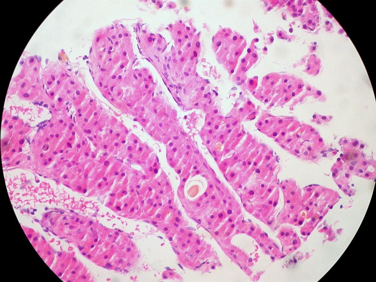 Hepatocellular carcinoma THC cancer drug