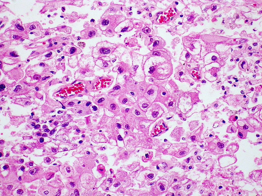 THC cancer drug for hepatocellular carcinoma -image courtesy of Wikipedia Commons