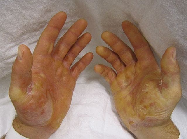 CBN treatment - hands with epidermolysis bullosa