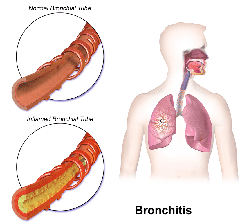 Bronchitis internal diagram