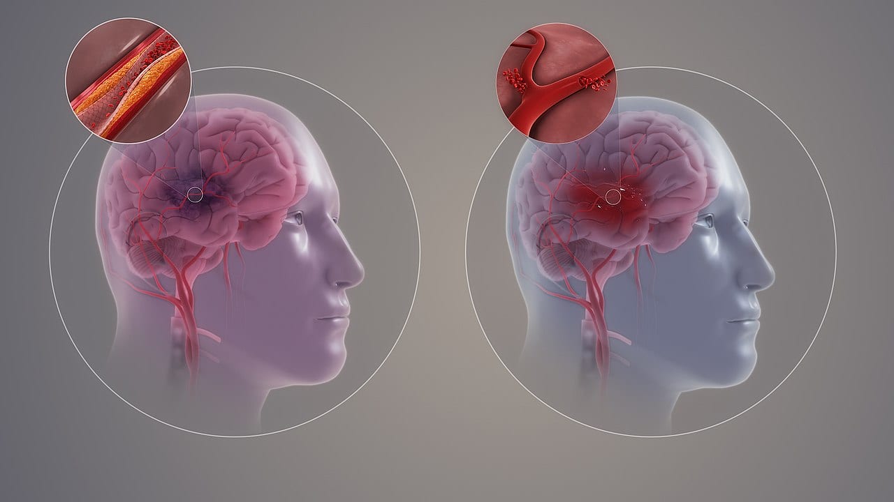 New data shows no link between weed use and strokes