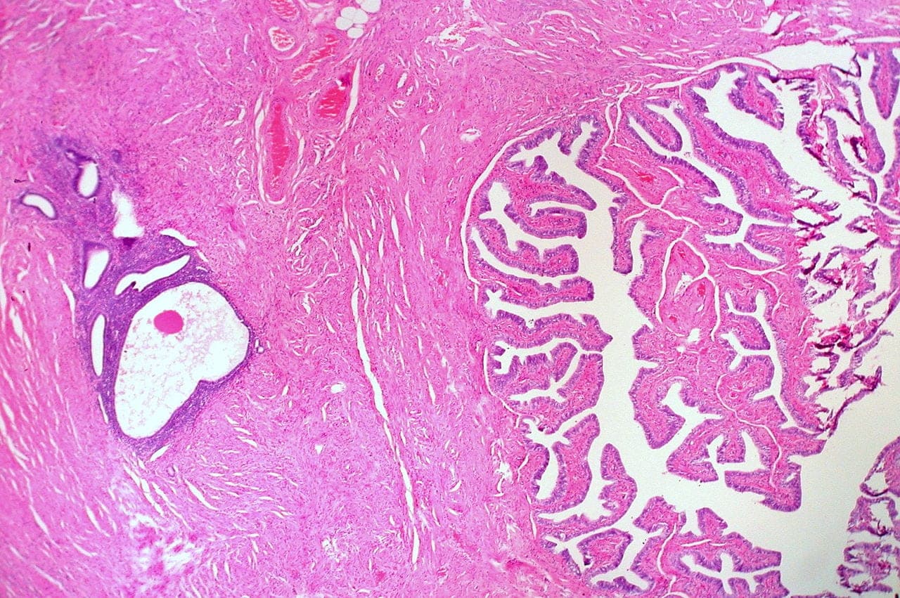 Endometriosis in the fallopian tube