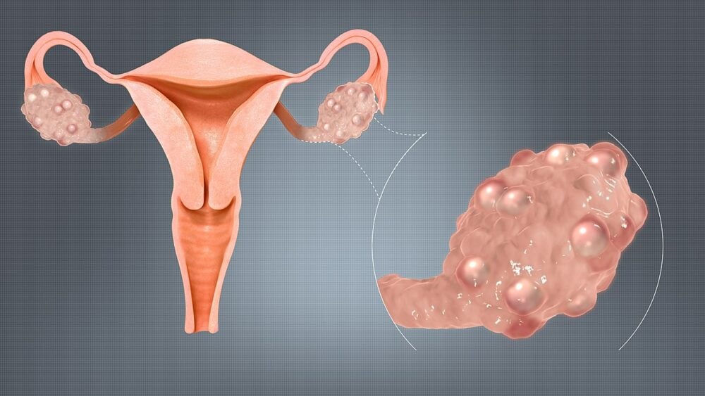 Artificial intelligence can be used to detect polycystic ovary syndrome: NIH study