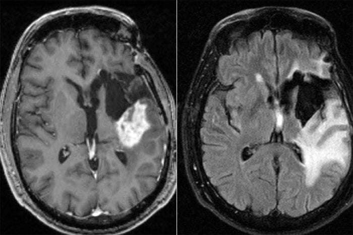 Tilray to provide cannabis for Spanish clinical study on severe brain cancer