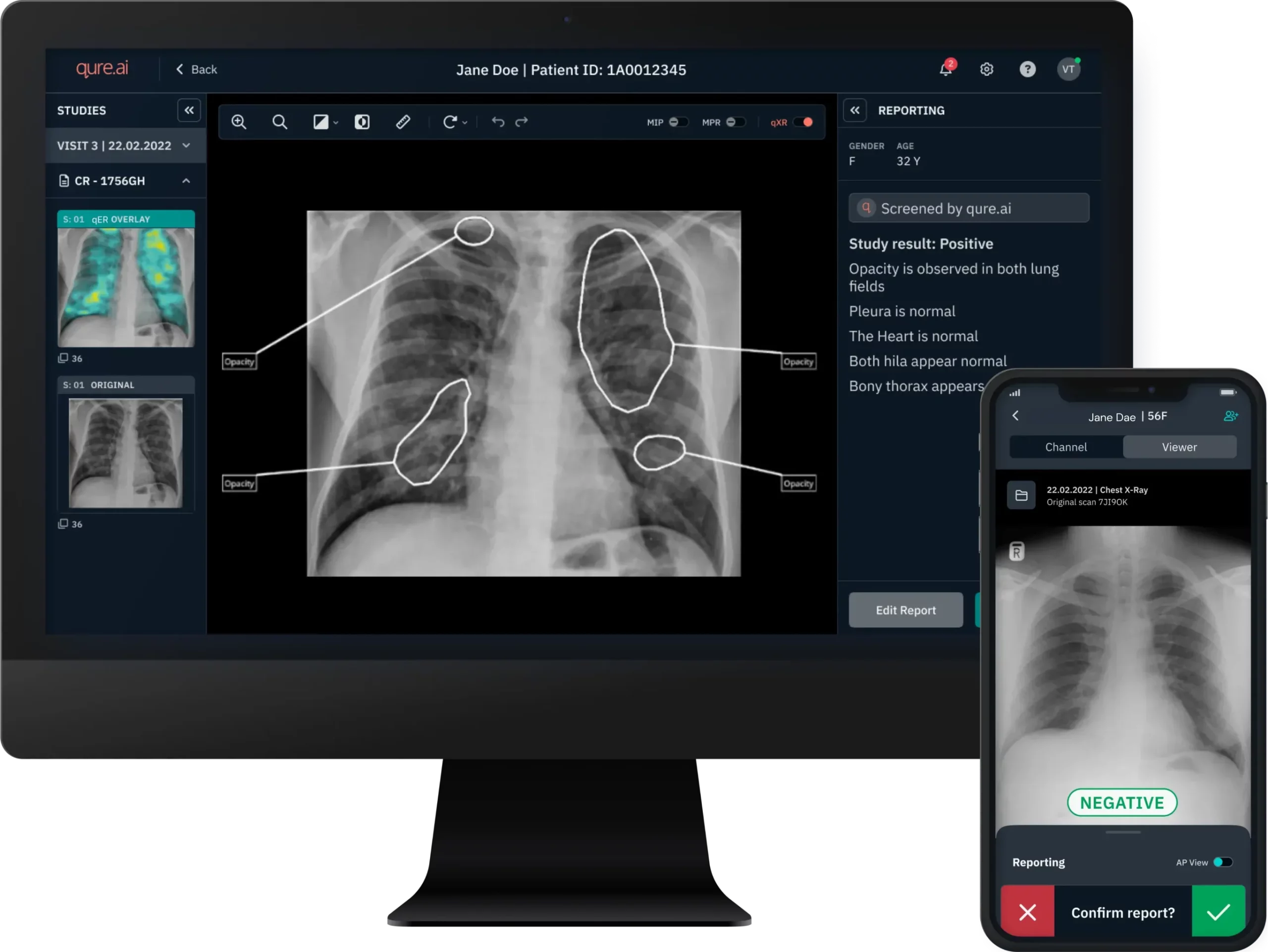 AI capable of identifying lung cancer years before symptoms manifest