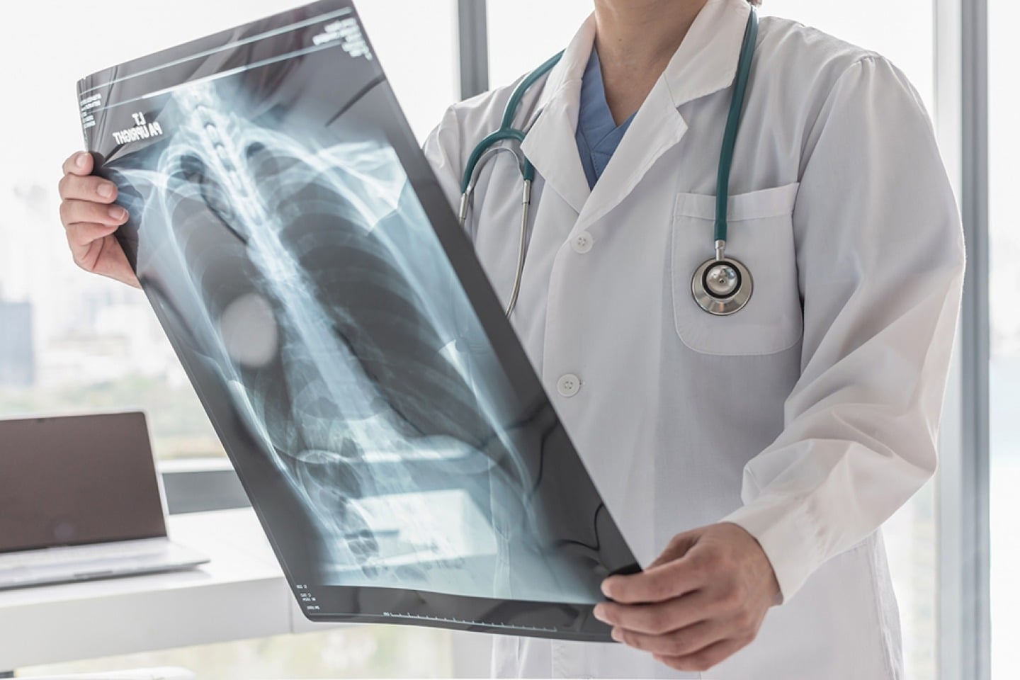 NYC Health + Hospitals completes over 10,000 lung cancer screenings since 2022