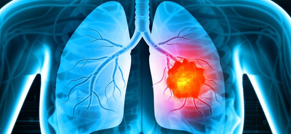 Robotic-assisted surgery and other tech spark demand in lung cancer surgery market