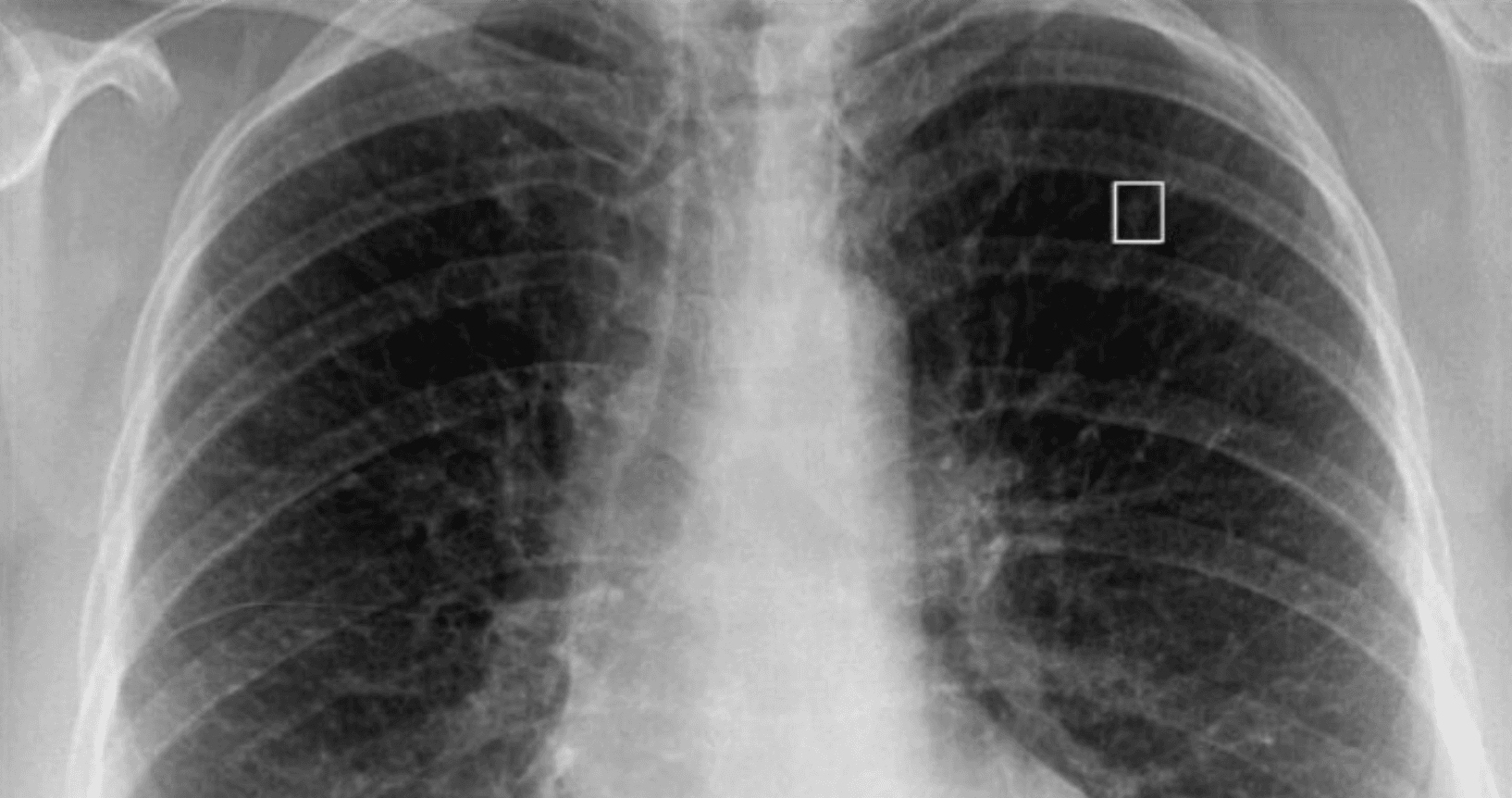 AI lung cancer screening tech developer, Imidex, seeks buyer at Chicago conference