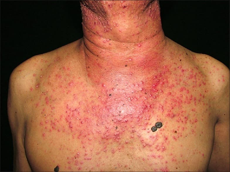 Hoth Therapeutics up over 200% on dermatology breakthrough for cancer patients