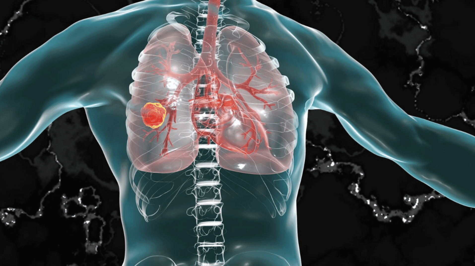 Early lung cancer diagnosis saves 52-year-old Indian man's life