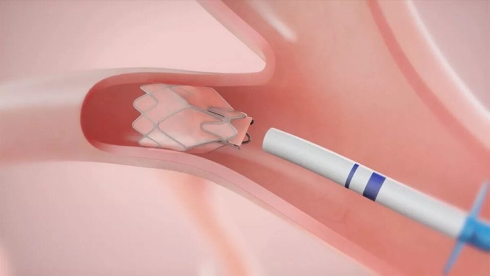 Pulmonx Corporation shares spike on record-breaking Q4 revenue