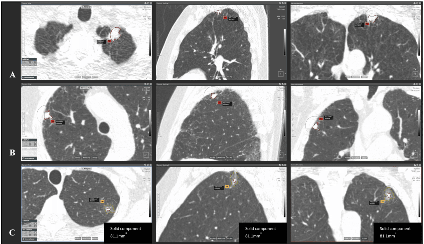 AI could help lessen radiologist lung cancer screening workload by up to 79%