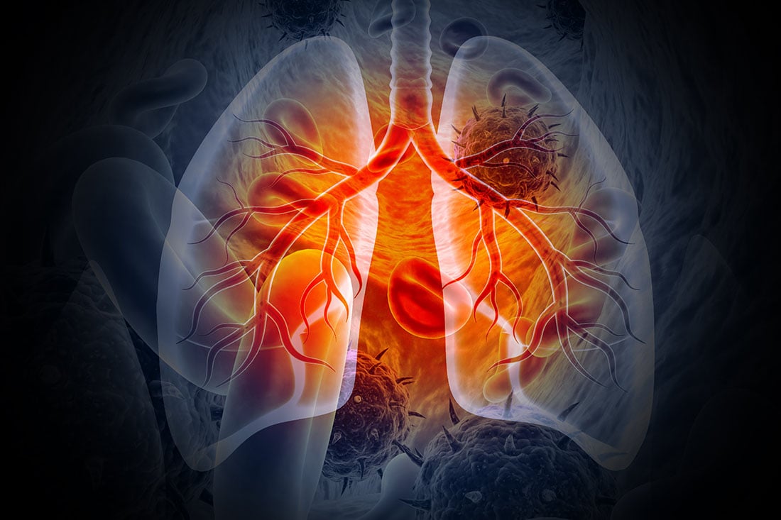 Nuvation Bio scoops US$250M financing to launch promising lung cancer therapeutic