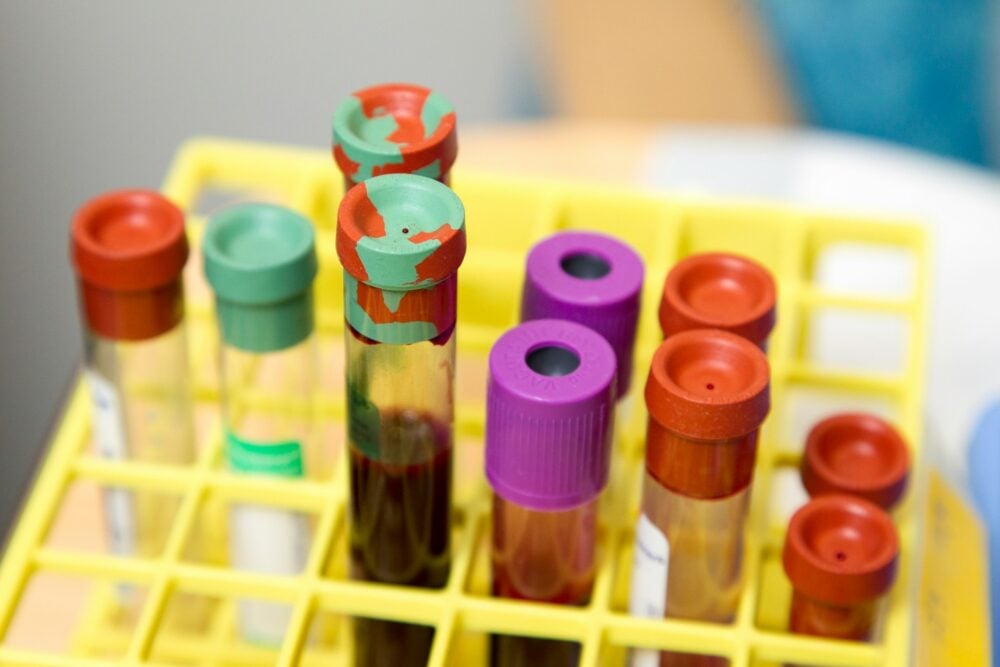 How could a simple blood test could eliminate tumour biopsies?