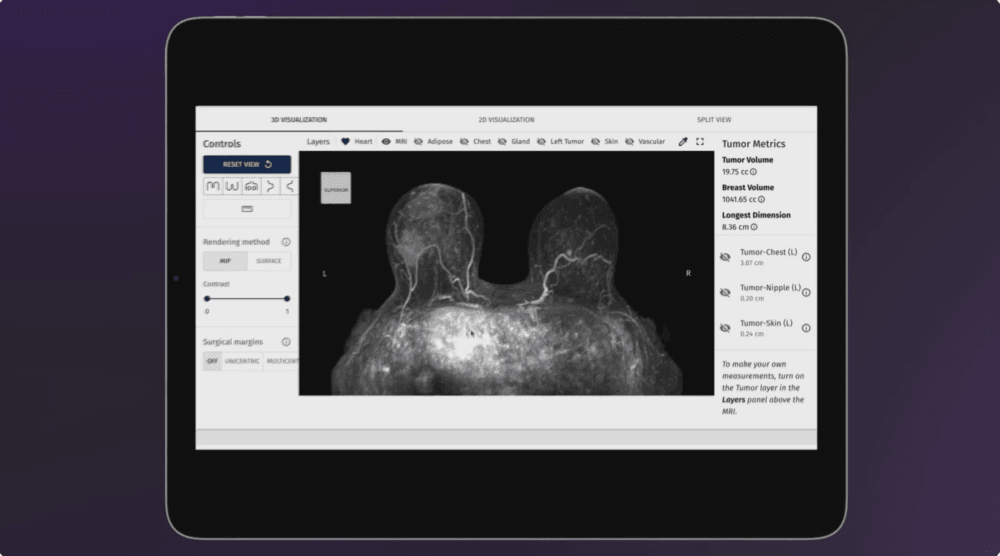 SimBioSys gets FDA nod for AI breast cancer platform
