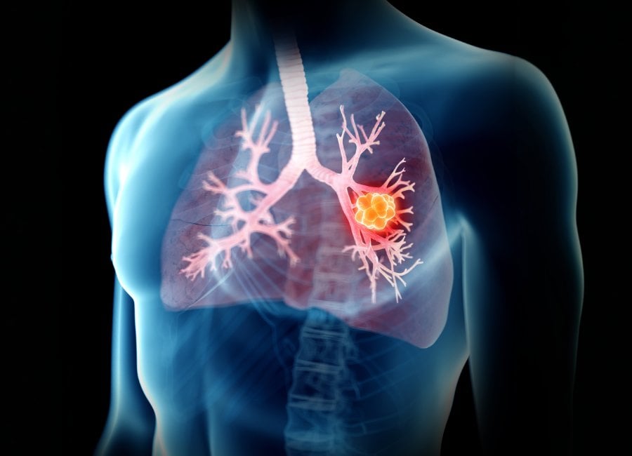 University of Bath spinout tests real-time lung biopsy device