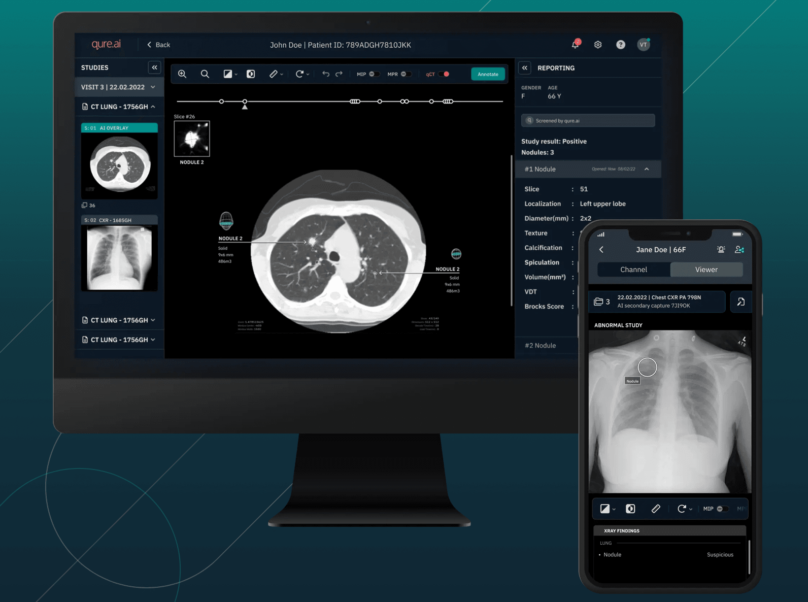 Malaysian health ministry uses AI to detect 22 lung cancer cases in 2 months