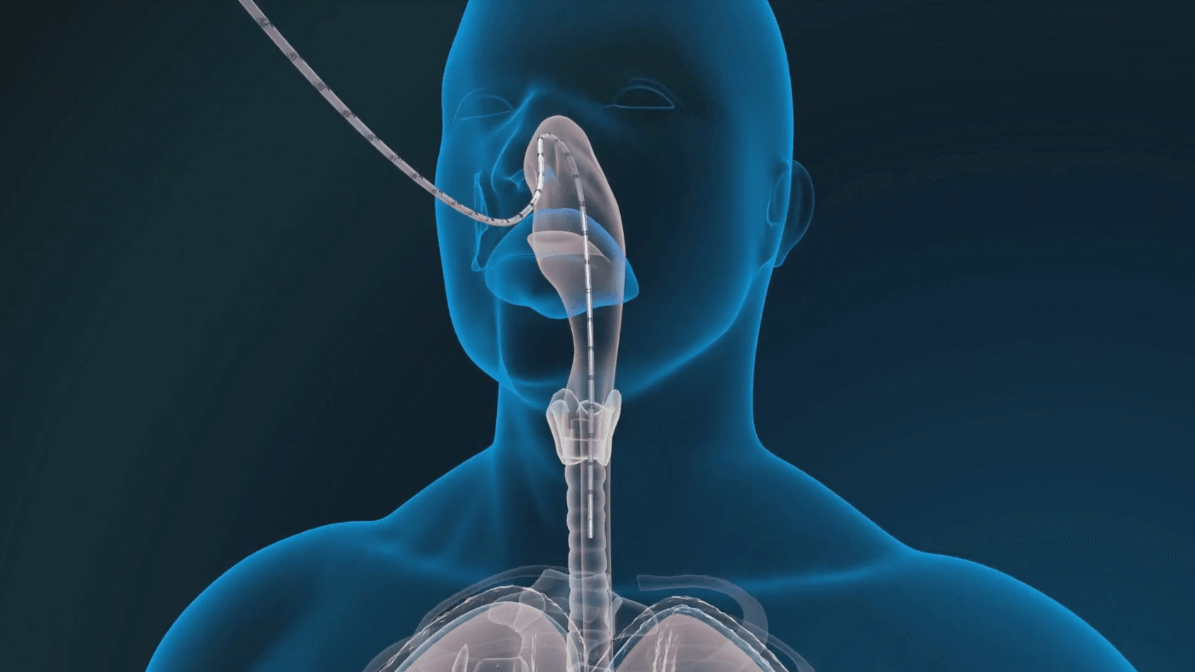 EnVue Medical skyrockets on reusable feeding tube syringe distribution deal