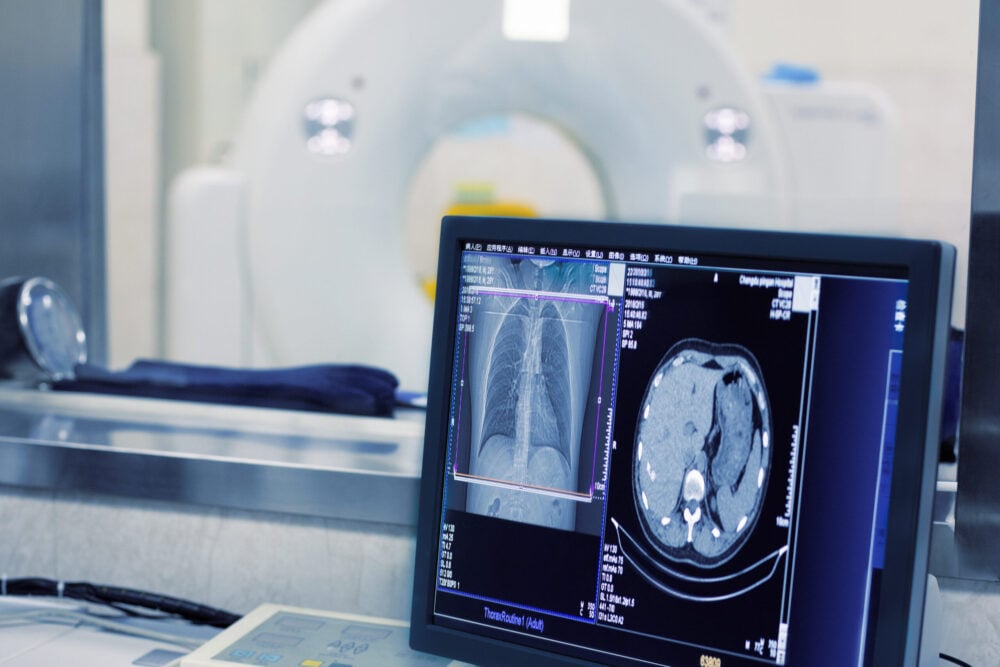 FDA clears Median Technologies lung-nodule risk assessment software