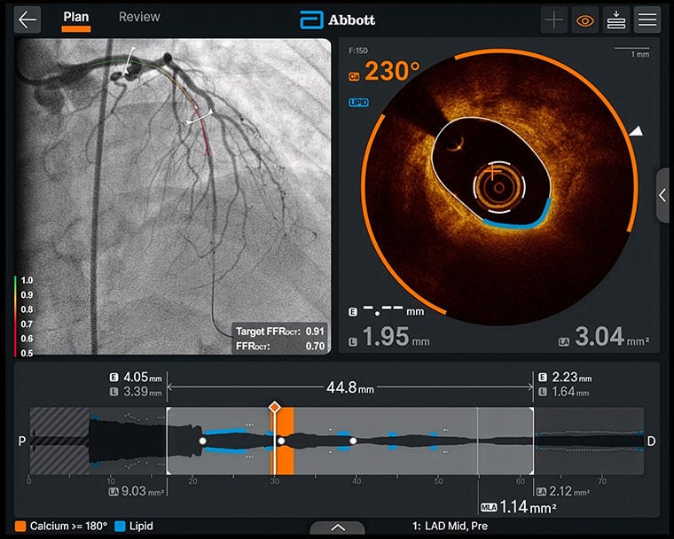 Abbott's coronary imaging tech secures regulatory wins with FDA clearance, CE mark