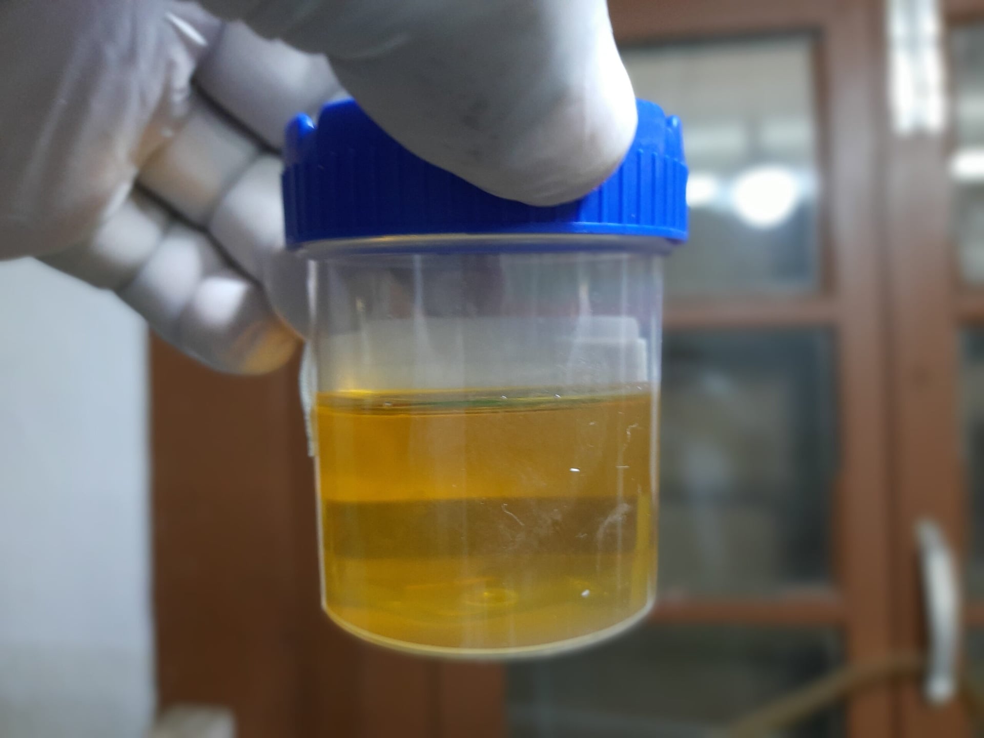 BioMark expands lung cancer screening portfolio with patented urine test
