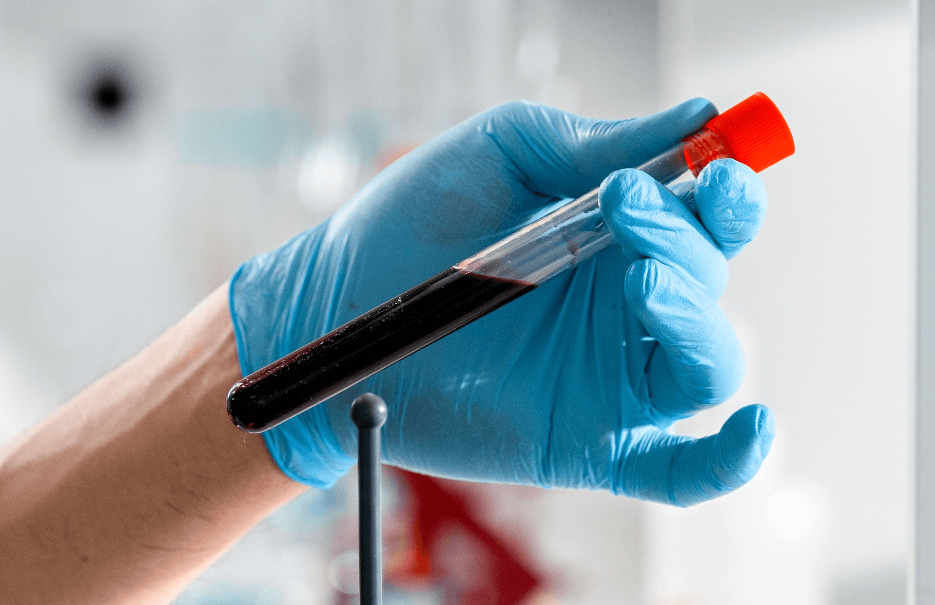 Liquid chromatography-mass spectrometry proves its worth in lung cancer screening