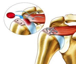 Rotator cuff