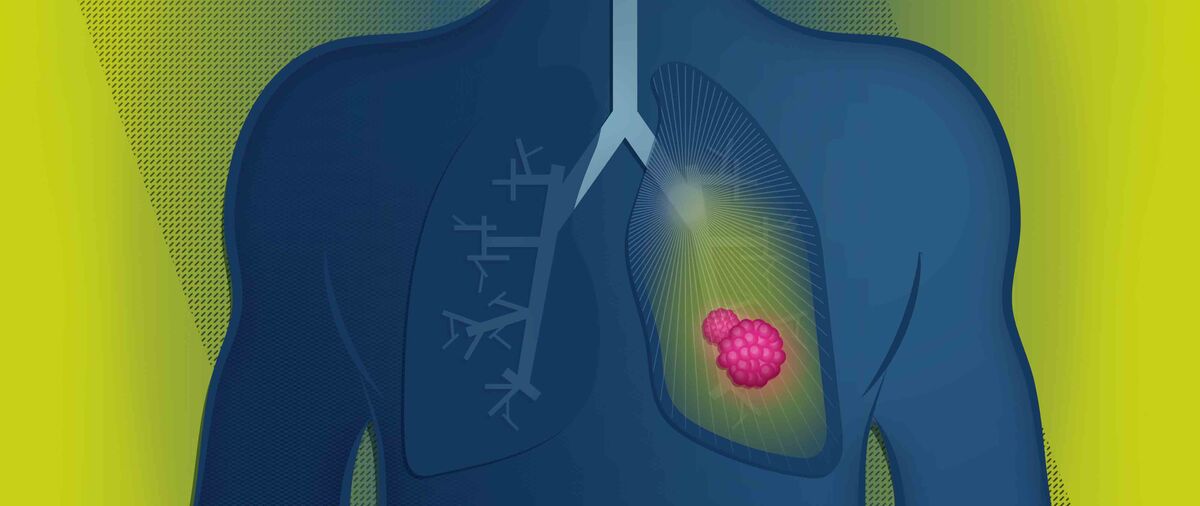 AstraZeneca shares slide on disappointing lung cancer drug trial results