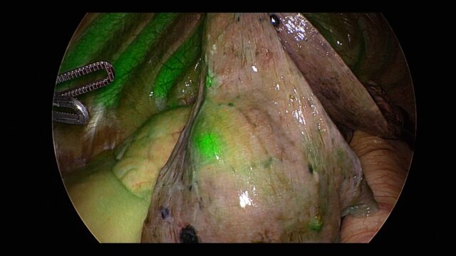 Oklahoma uses injectable 'glowing' agent to light up lung cancer cells in surgery