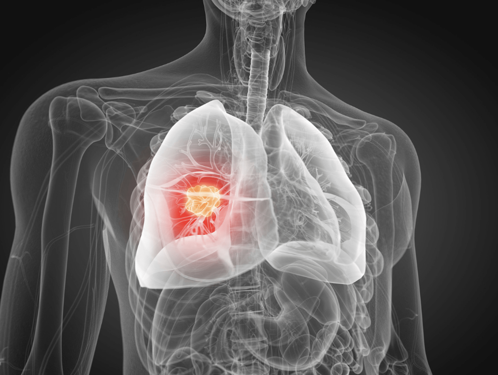 Deep learning AI model proves itself useful for detecting tumours on CT imaging