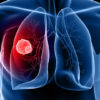 Australia's first national lung cancer screening program begins in July