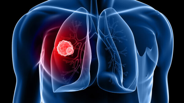 Australia's first national lung cancer screening program begins in July