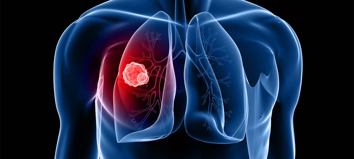 Australia's first national lung cancer screening program begins in July
