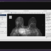 SimBioSys gets FDA nod for AI breast cancer platform