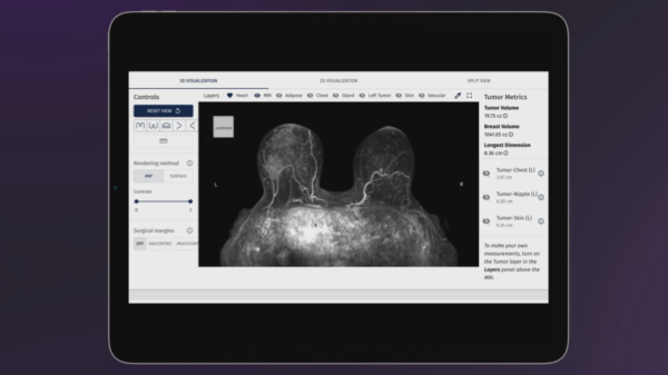 SimBioSys gets FDA nod for AI breast cancer platform