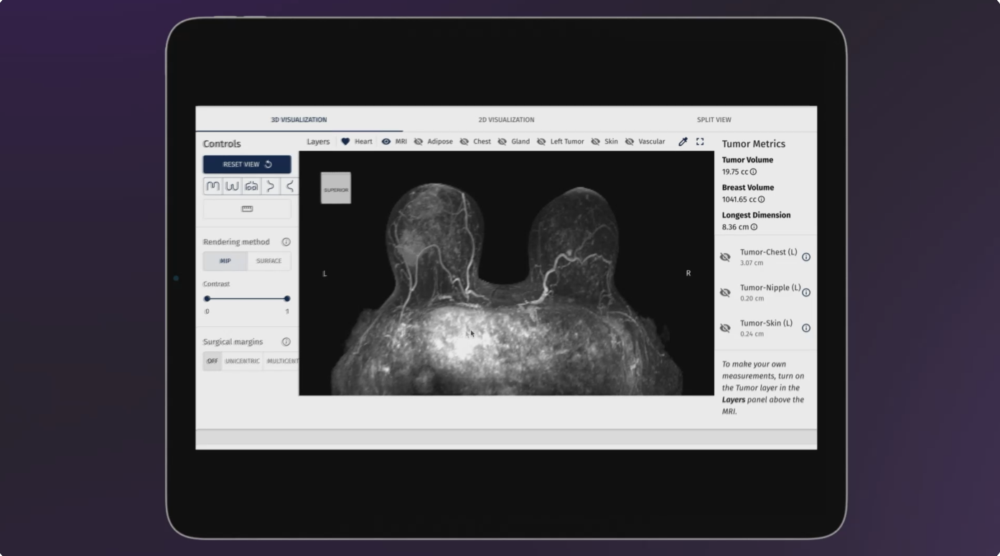 SimBioSys gets FDA nod for AI breast cancer platform