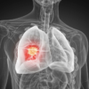 Lung cancer remains top Canadian killer despite drastically improved survival rate