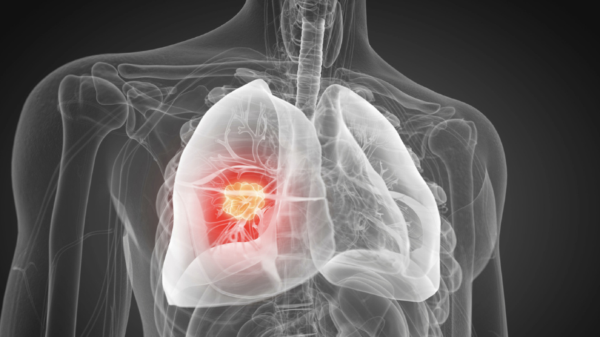 Lung cancer remains top Canadian killer despite drastically improved survival rate
