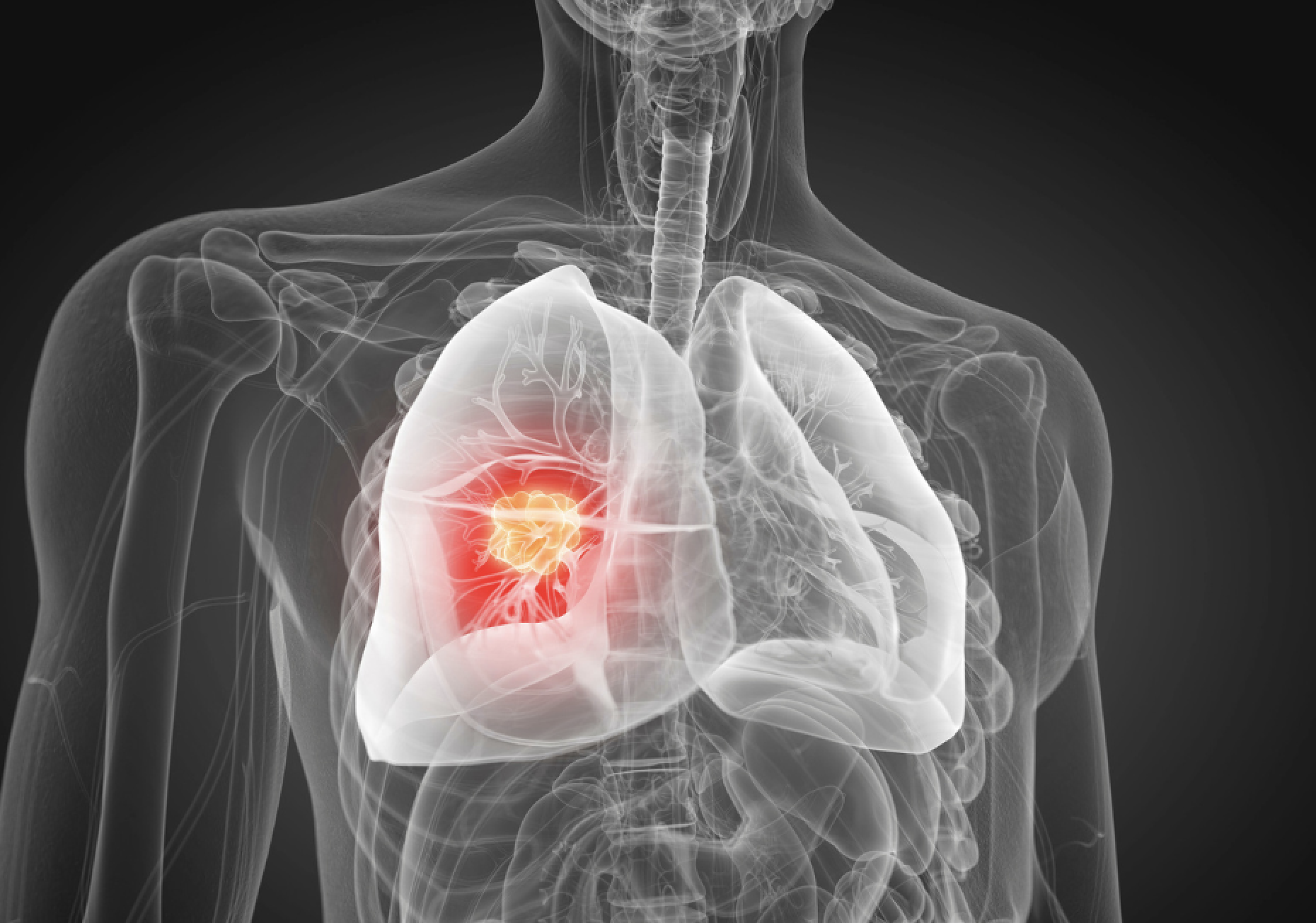Lung cancer remains top Canadian killer despite drastically improved survival rate