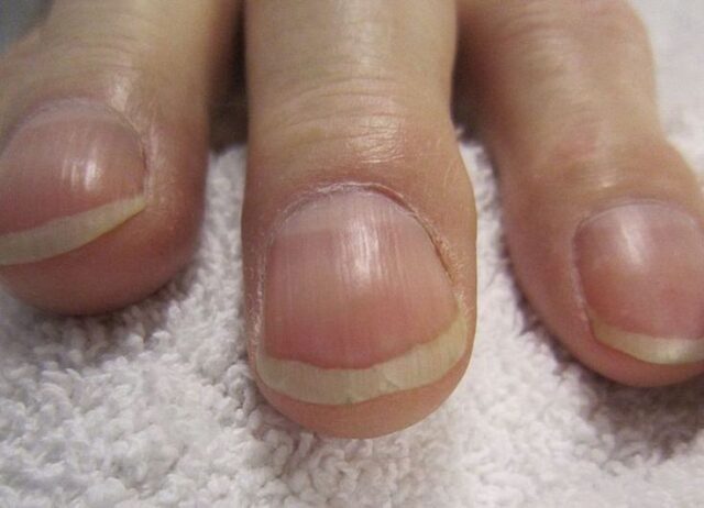 New York doctor warns that change in fingernails can be linked to lung cancer