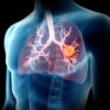 University of Bath spinout tests real-time lung biopsy device