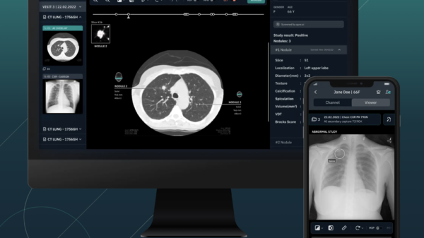 Malaysian health ministry uses AI to detect 22 lung cancer cases in 2 months
