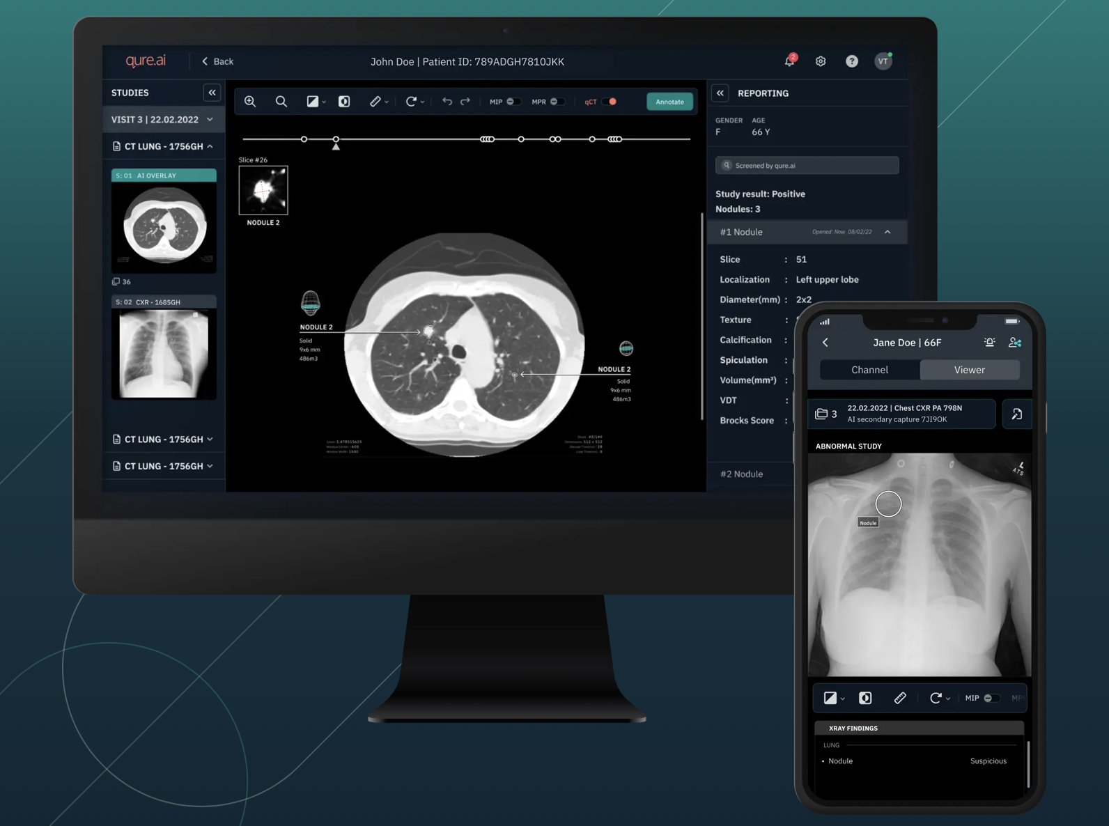 Malaysian health ministry uses AI to detect 22 lung cancer cases in 2 months
