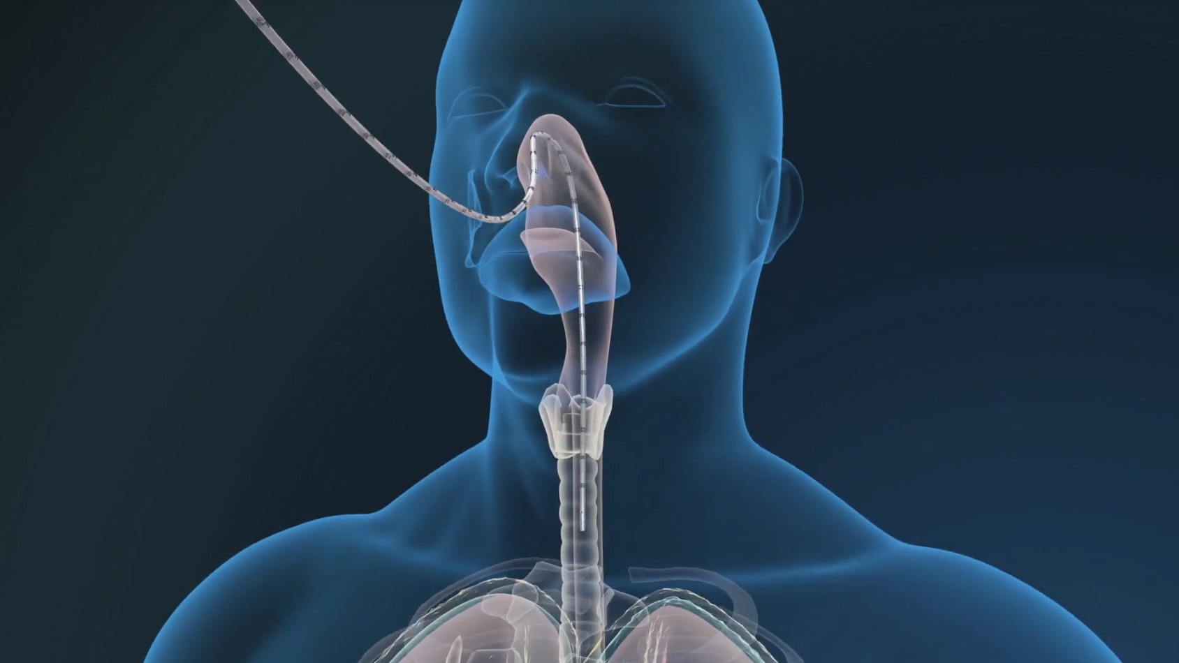 EnVue Medical skyrockets on reusable feeding tube syringe distribution deal