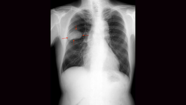 Allarity Therapeutics doses first patients in VA-funded small cell lung cancer trial