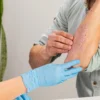 Biopharma companies Evommune and Nektar soar on eczema treatment data