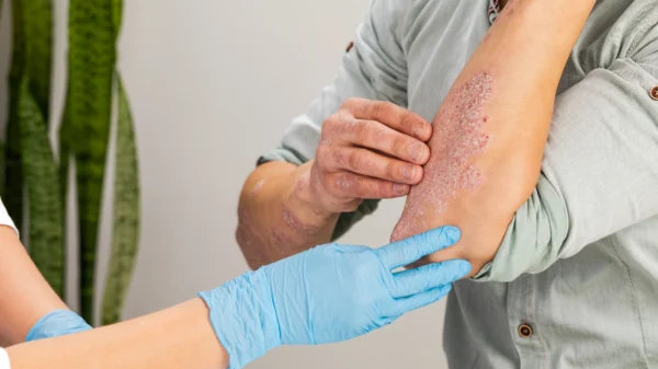 Biopharma companies Evommune and Nektar soar on eczema treatment data